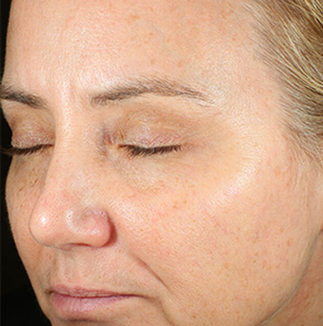 Before and After results from using Brightalive® for 16 weeks