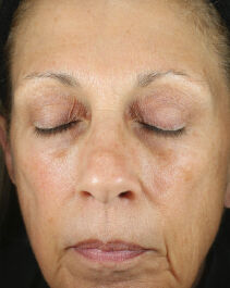 Renewal Crème  before-after-1